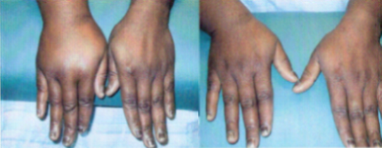 Upper Extremity Lymphedema 1